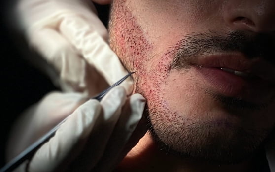Eyebrow Transplant