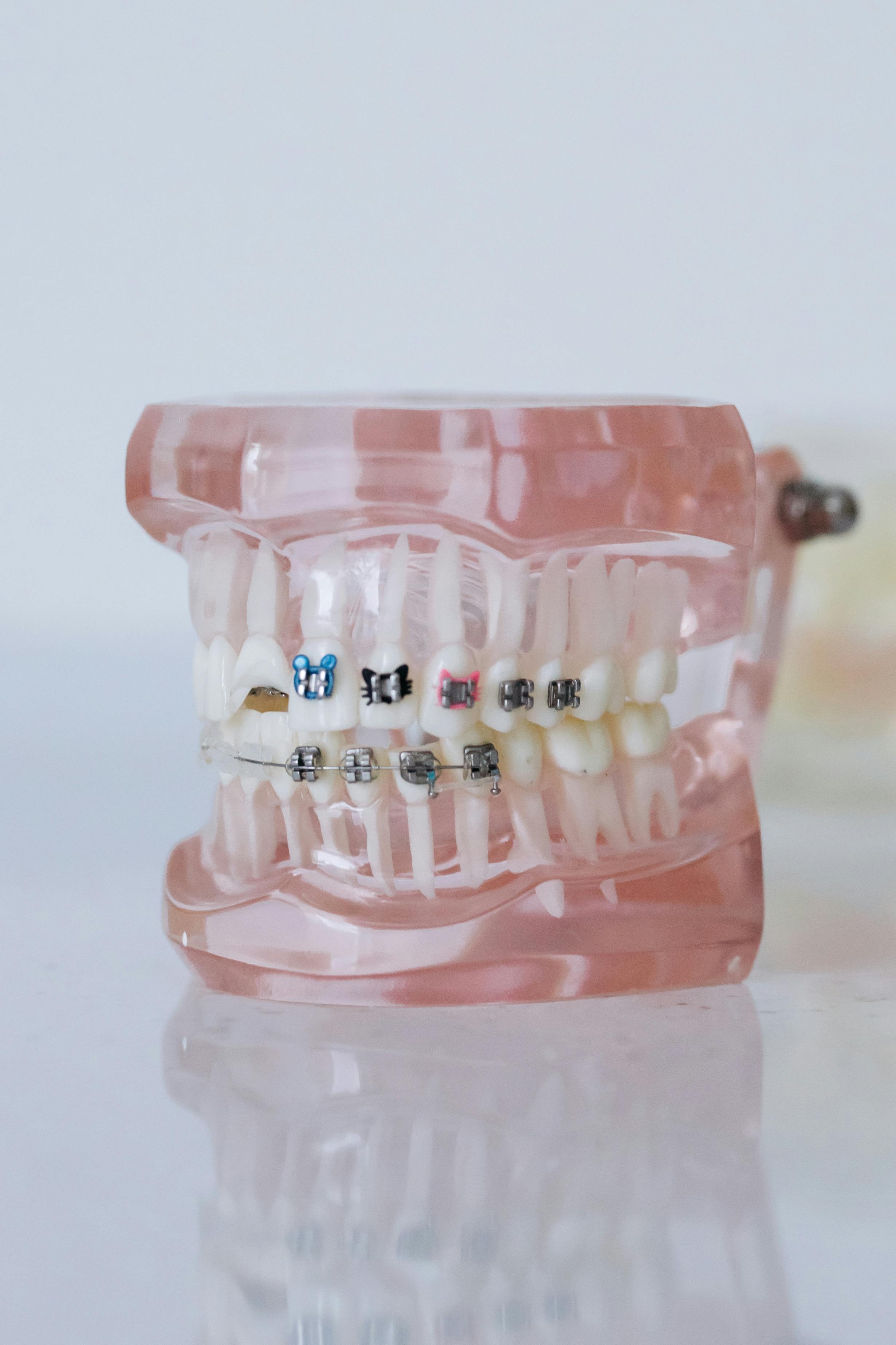 Dental Braces