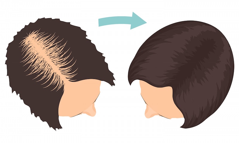 Women Hair Restoration